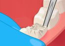 Operate Now! Dental Implant